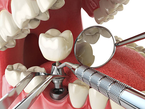 Best Emergency Root Canal Treatment in Rio Del Mar, CA